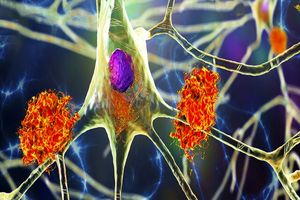 کشف یک جهش ژنی با احتمال کاهش خطر آلزایمر 1 کشف یک جهش ژنی با احتمال کاهش خطر آلزایمر