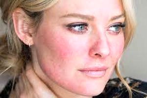 صورت تان زود به زود سرخ می‌شود؟