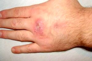 مواد شوینده لباسشویی سد محافظتی پوست را تضعیف می‌کند