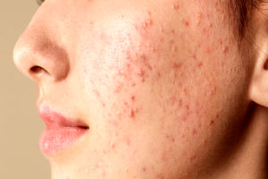 چرا جوش می‌زنیم؟