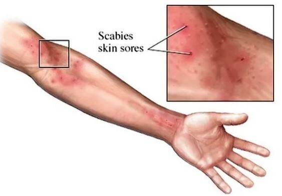 شیوع یک بیماری مُسری در انگلیس 4 شیوع یک بیماری مُسری در انگلیس؛ متخصصان نگران کمبود دارو هستند