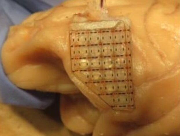 پیشگیری از اعتیاد به قمار با کاشت یک تراشه در مغز!/ عکس 3 مغز1