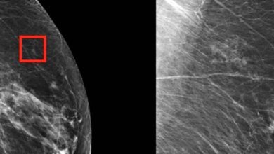 هوش مصنوعی و اثری باورنکردنی در تشخیص سرطان سینه_بام وطن 4 هوش مصنوعی و اثری باورنکردنی در تشخیص سرطان سینه
