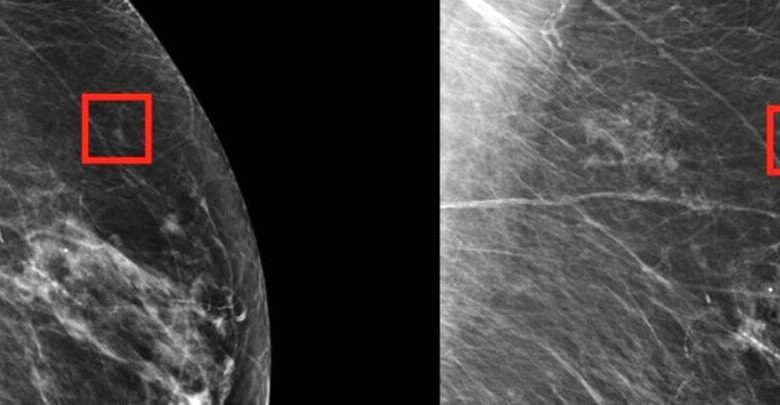 هوش مصنوعی و اثری باورنکردنی در تشخیص سرطان سینه_بام وطن 1 هوش مصنوعی و اثری باورنکردنی در تشخیص سرطان سینه