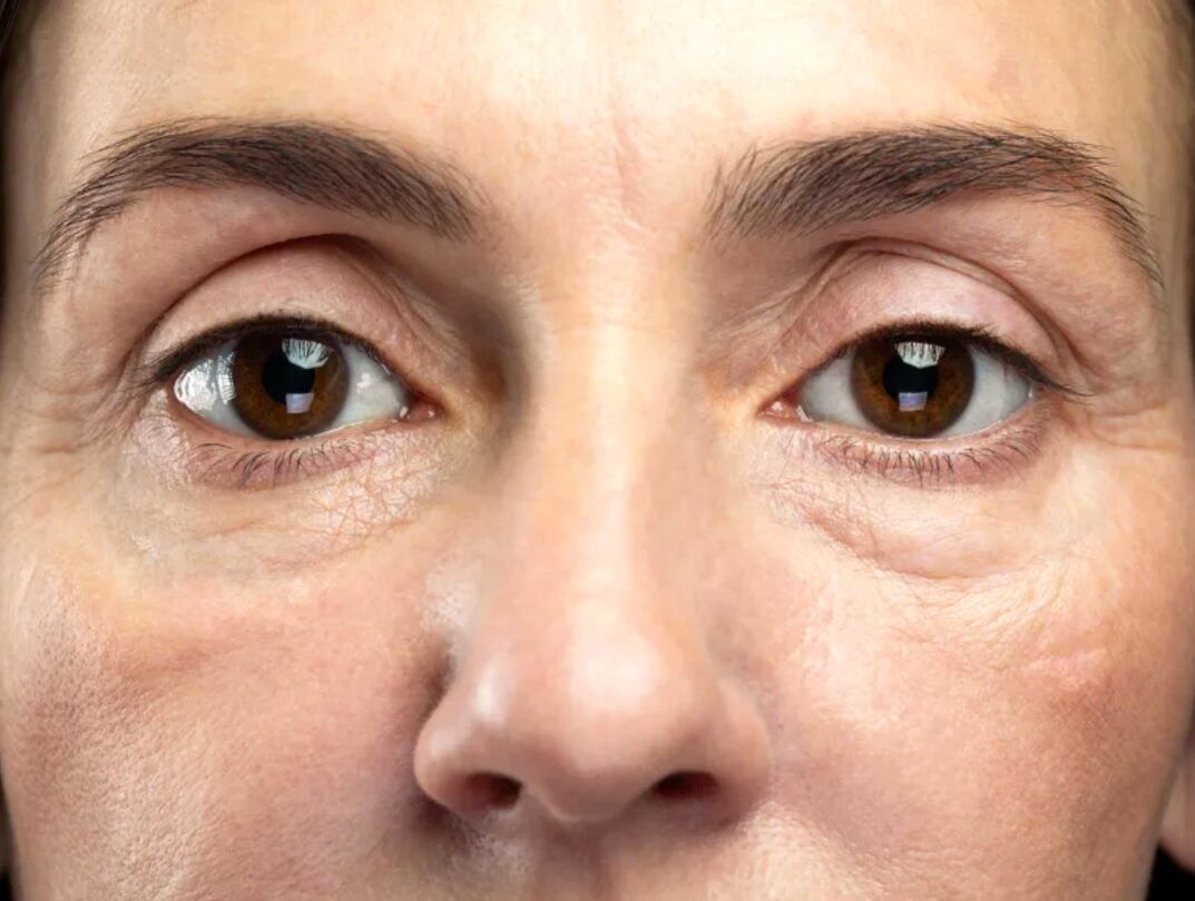 پف زیر چشم و درمان آن_بام وطن 4 پف زیر چشم و درمان آن