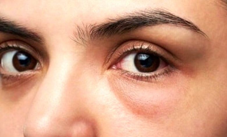 پف زیر چشم و درمان آن_بام وطن 3 پف زیر چشم و درمان آن