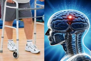 2 فرد مبتلا به صدمه نخاعی بعد از کاشت الکترود در مغزشان، مسافت کوتاهی راه رفتند_بام وطن 2 2 فرد مبتلا به آسیب نخاعی پس از کاشت الکترود در مغزشان، مسافت کوتاهی راه رفتند