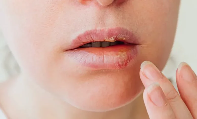 تبخال زدن احتمال آلزایمر را تقویت می‌کند