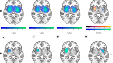 رابطه جدا گانه لرزش در بیماری پارکینسون با کارکرد دوپامین در مغز_بام وطن 4 1