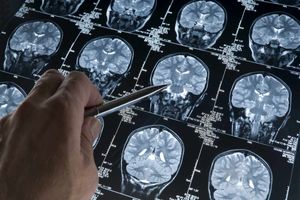 دانشمندان علت جدیدی برای بیماری آلزایمر کشف کردند_بام وطن 3 دانشمندان علت جدیدی برای بیماری آلزایمر کشف کردند